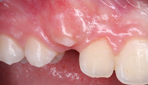 Publications Dr Nicolas HENNER Abord Parodontale des dents