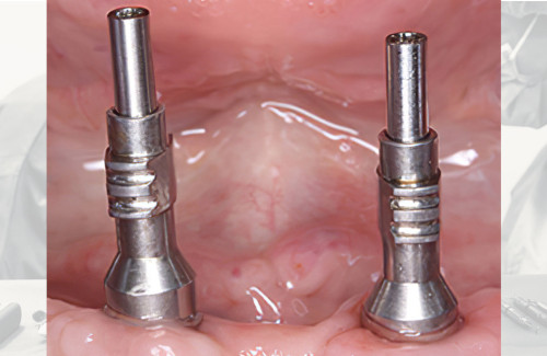 formations implantologie orale Nîmes prothèses sur implants